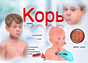 Симптомы кори у детей, лечение и меры профилактики
