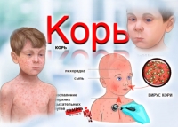 Симптомы кори у детей, лечение и меры профилактики