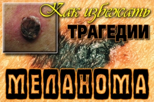 В СПб ГБУЗ КВД №11 ДЕНЬ ДИАГНОСТИКИ МЕЛАНОМЫ!
